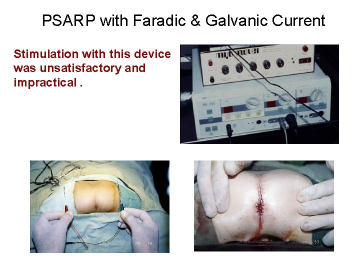 PSARP with Faradic & Galvanic Current Stimulation with this device was unsatisfactory and impractical.