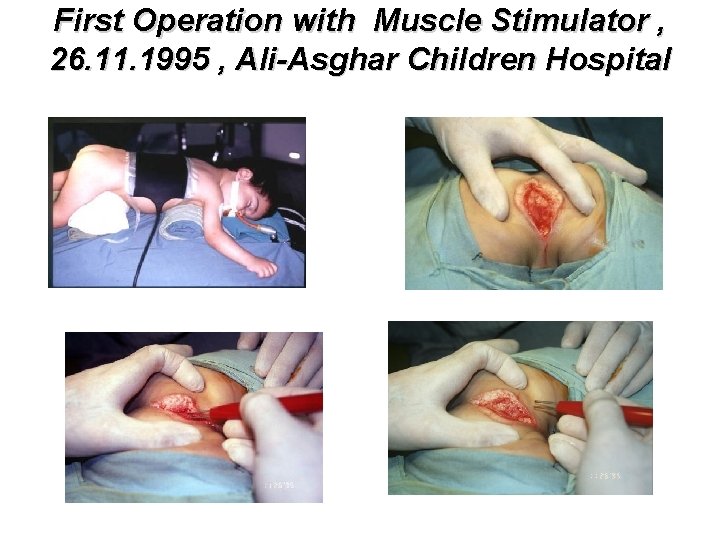 First Operation with Muscle Stimulator , 26. 11. 1995 , Ali-Asghar Children Hospital 