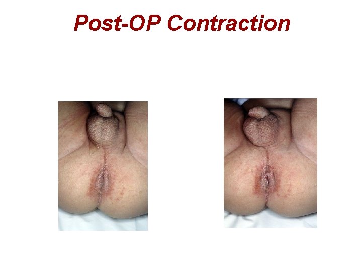 Post-OP Contraction 
