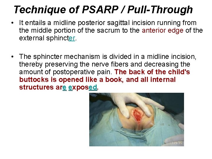 Technique of PSARP / Pull-Through • It entails a midline posterior sagittal incision running