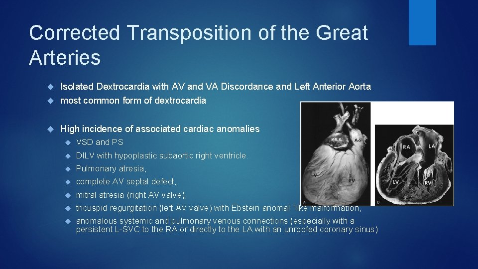 Corrected Transposition of the Great Arteries Isolated Dextrocardia with AV and VA Discordance and