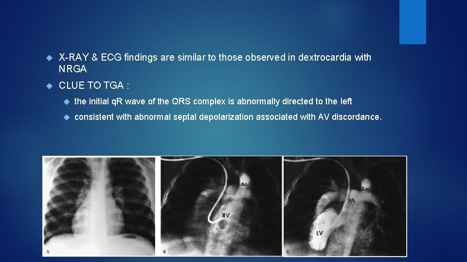  X-RAY & ECG findings are similar to those observed in dextrocardia with NRGA