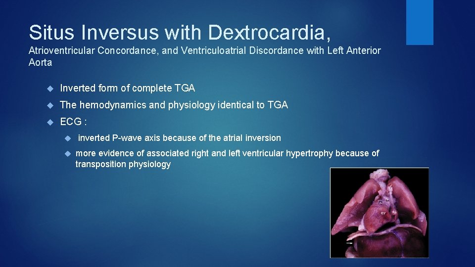Situs Inversus with Dextrocardia, Atrioventricular Concordance, and Ventriculoatrial Discordance with Left Anterior Aorta Inverted