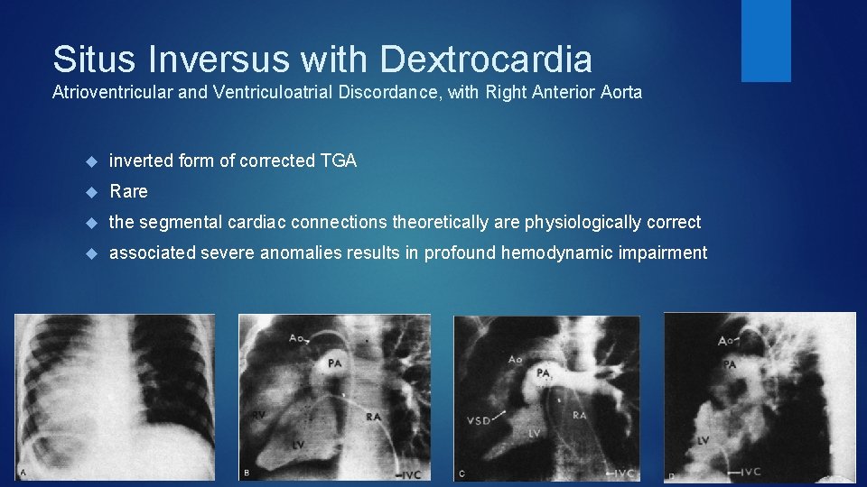 Situs Inversus with Dextrocardia Atrioventricular and Ventriculoatrial Discordance, with Right Anterior Aorta inverted form