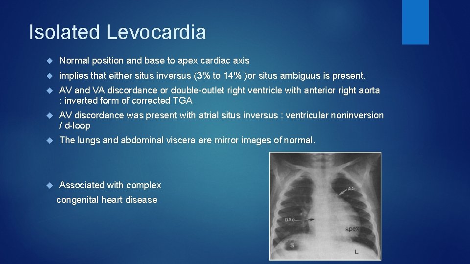 Isolated Levocardia Normal position and base to apex cardiac axis implies that either situs