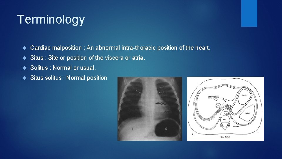 Terminology Cardiac malposition : An abnormal intra-thoracic position of the heart. Situs : Site