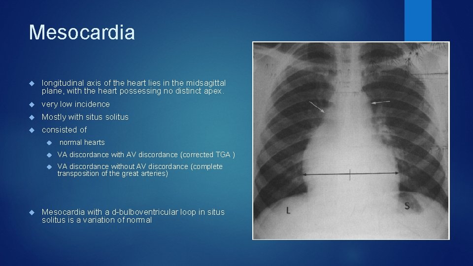 Mesocardia longitudinal axis of the heart lies in the midsagittal plane, with the heart