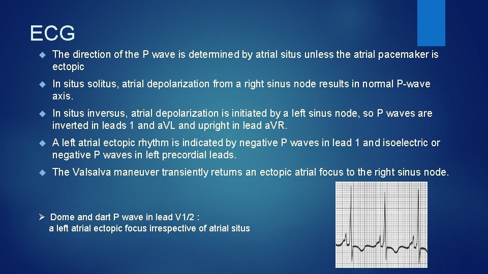 ECG The direction of the P wave is determined by atrial situs unless the