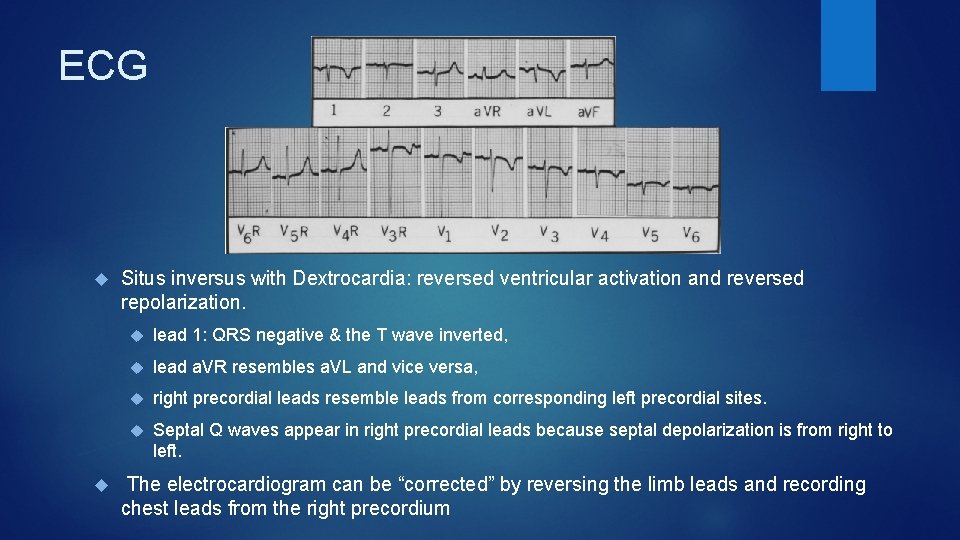 ECG Situs inversus with Dextrocardia: reversed ventricular activation and reversed repolarization. lead 1: QRS