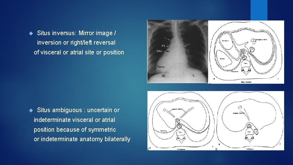  Situs inversus: Mirror image / inversion or right/left reversal of visceral or atrial