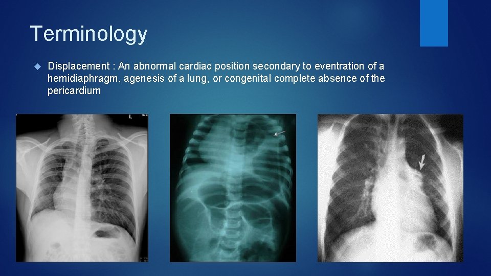 Terminology Displacement : An abnormal cardiac position secondary to eventration of a hemidiaphragm, agenesis