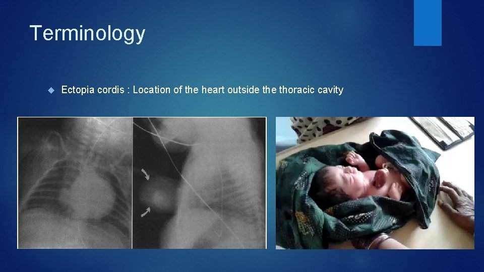 Terminology Ectopia cordis : Location of the heart outside thoracic cavity 