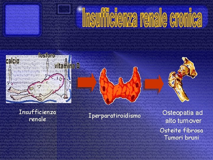 Insufficienza renale Iperparatiroidismo Osteopatia ad alto turnover Osteite fibrosa Tumori bruni 