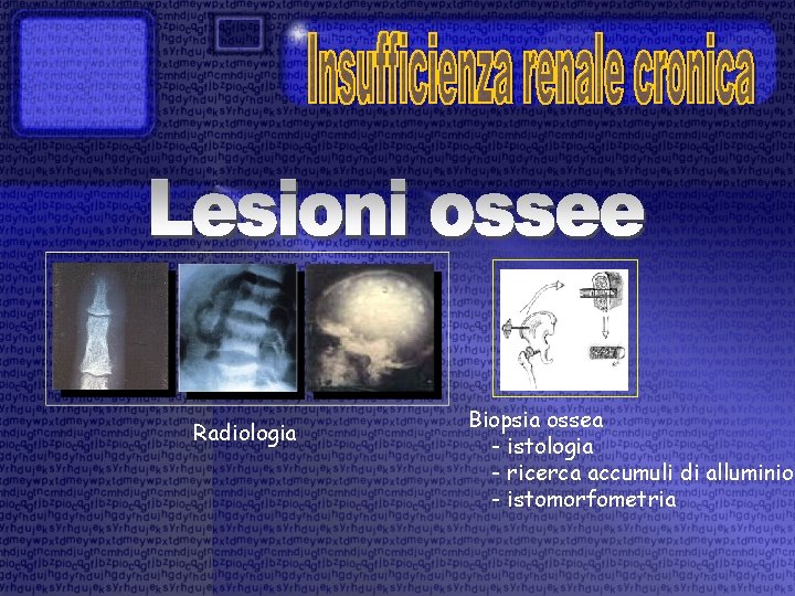 Radiologia Biopsia ossea - istologia - ricerca accumuli di alluminio - istomorfometria 