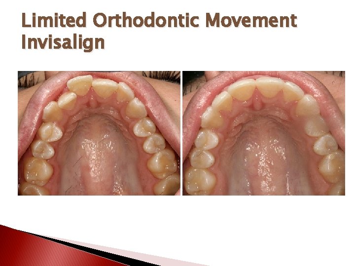 Limited Orthodontic Movement Invisalign 
