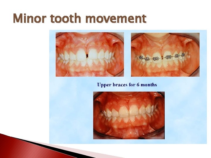 Minor tooth movement 