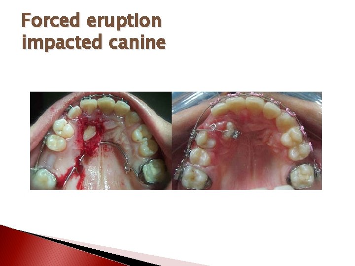 Forced eruption impacted canine 
