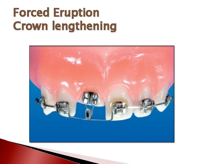 Forced Eruption Crown lengthening 