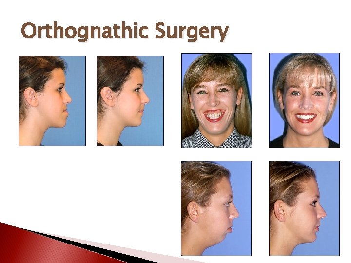 Orthognathic Surgery 