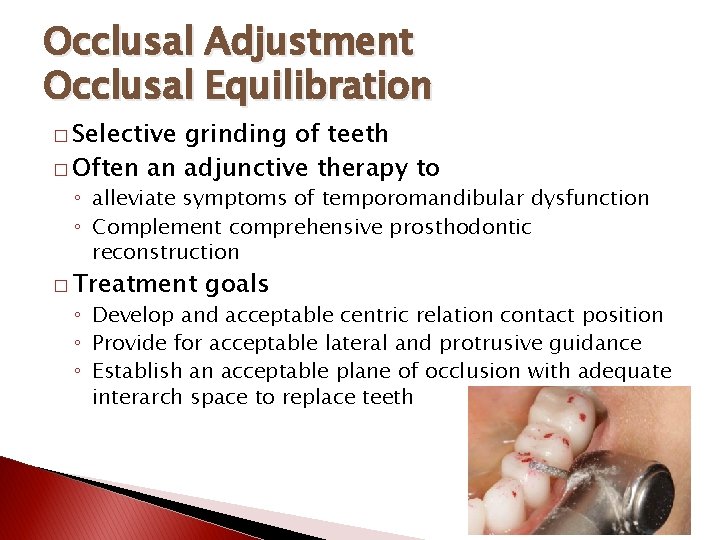 Occlusal Adjustment Occlusal Equilibration � Selective grinding of teeth � Often an adjunctive therapy