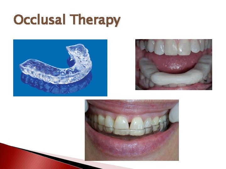 Occlusal Therapy 