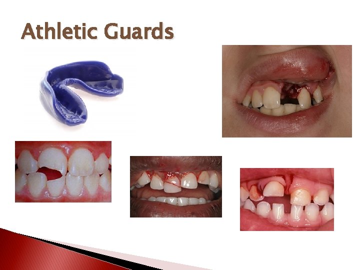Athletic Guards 