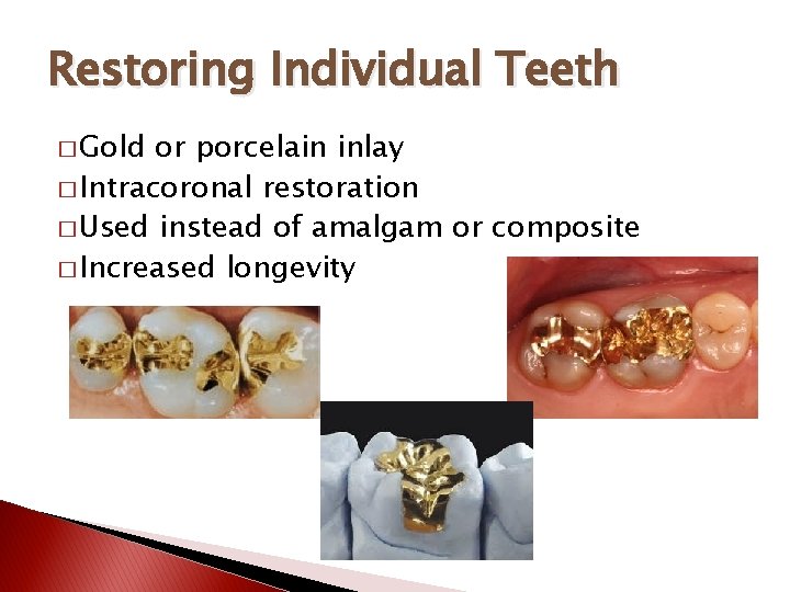 Restoring Individual Teeth � Gold or porcelain inlay � Intracoronal restoration � Used instead
