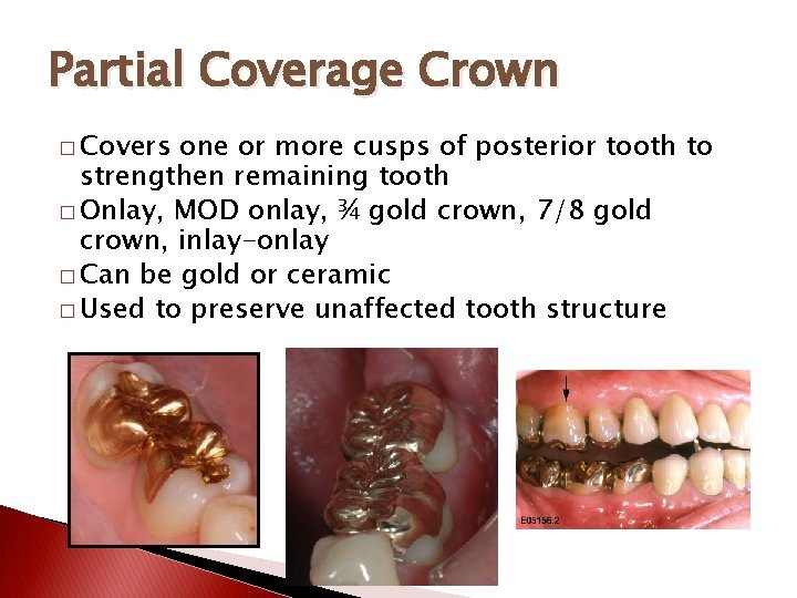 Partial Coverage Crown � Covers one or more cusps of posterior tooth to strengthen