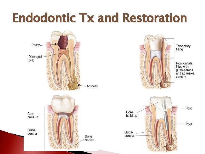 Endodontic Tx and Restoration 