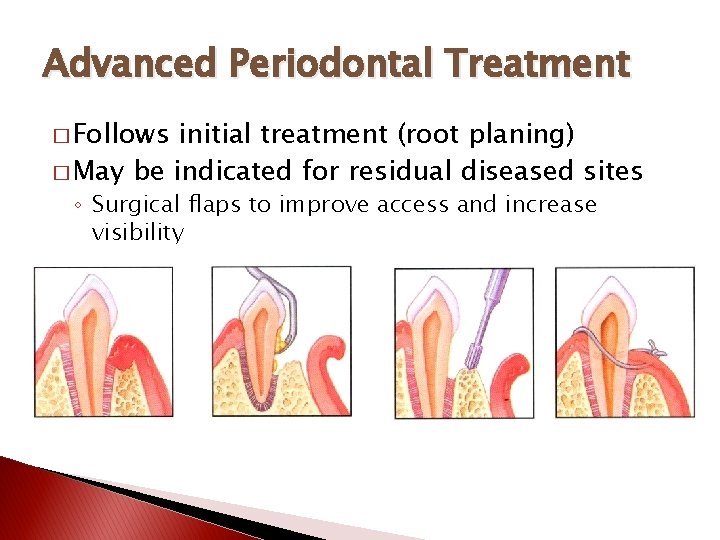 Advanced Periodontal Treatment � Follows initial treatment (root planing) � May be indicated for