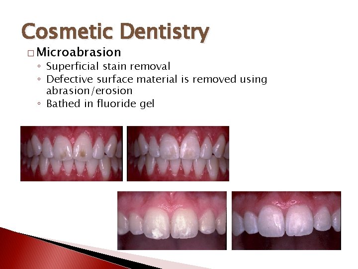 Cosmetic Dentistry � Microabrasion ◦ Superficial stain removal ◦ Defective surface material is removed