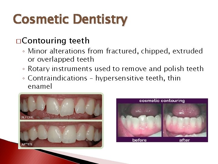 Cosmetic Dentistry � Contouring teeth ◦ Minor alterations from fractured, chipped, extruded or overlapped