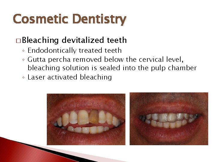Cosmetic Dentistry � Bleaching devitalized teeth ◦ Endodontically treated teeth ◦ Gutta percha removed