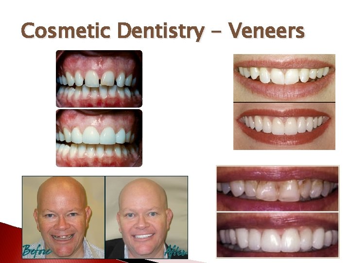 Cosmetic Dentistry - Veneers 