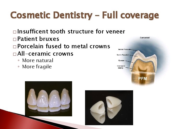 Cosmetic Dentistry – Full coverage � Insufficent tooth structure for veneer � Patient bruxes