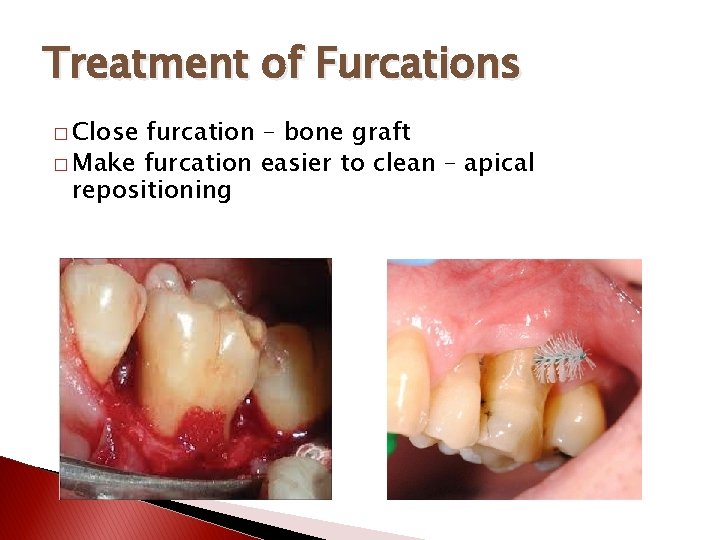 Treatment of Furcations � Close furcation – bone graft � Make furcation easier to