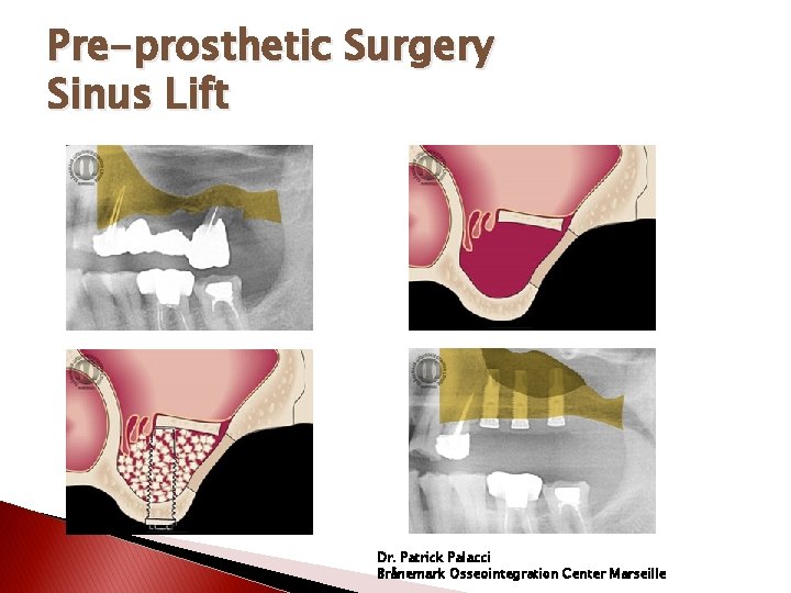 Pre-prosthetic Surgery Sinus Lift Dr. Patrick Palacci Brånemark Osseointegration Center Marseille 