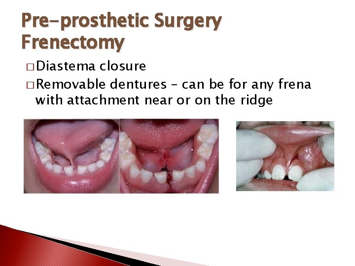 Pre-prosthetic Surgery Frenectomy � Diastema closure � Removable dentures – can be for any