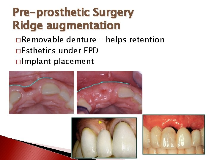 Pre-prosthetic Surgery Ridge augmentation � Removable denture – helps retention � Esthetics under FPD