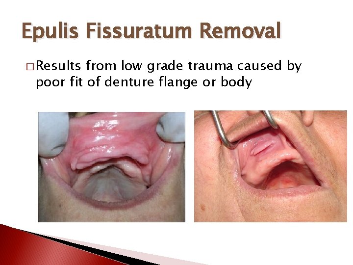 Epulis Fissuratum Removal � Results from low grade trauma caused by poor fit of