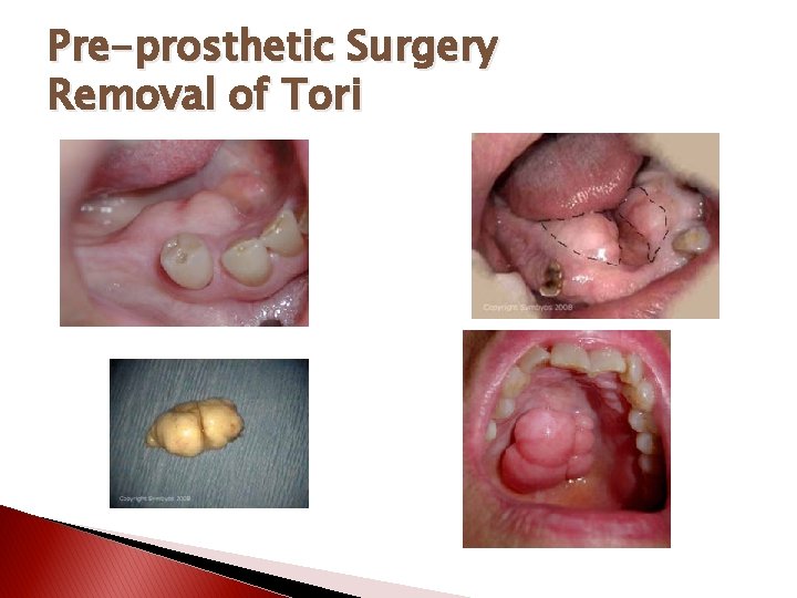 Pre-prosthetic Surgery Removal of Tori 