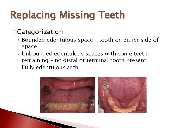 Replacing Missing Teeth � Categorization ◦ Bounded edentulous space – tooth on either side