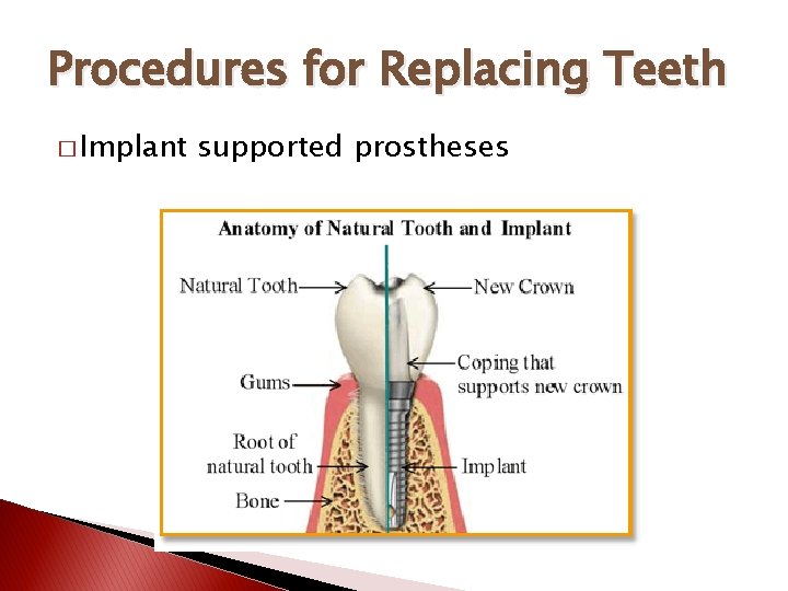 Procedures for Replacing Teeth � Implant supported prostheses 