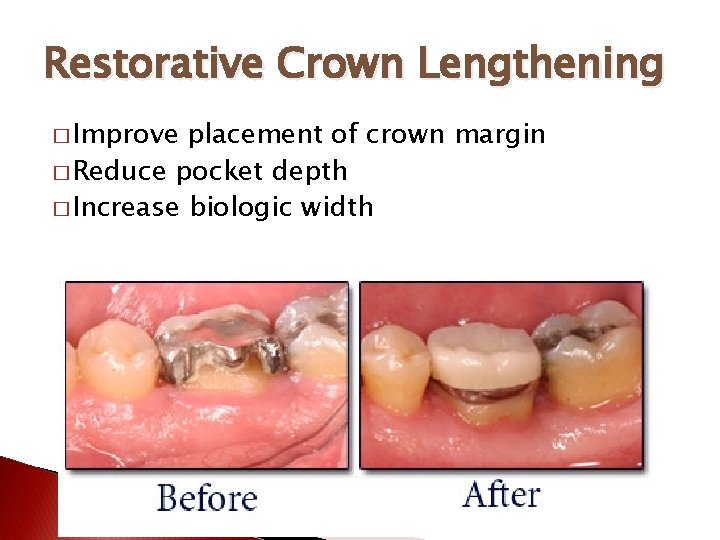 Restorative Crown Lengthening � Improve placement of crown margin � Reduce pocket depth �