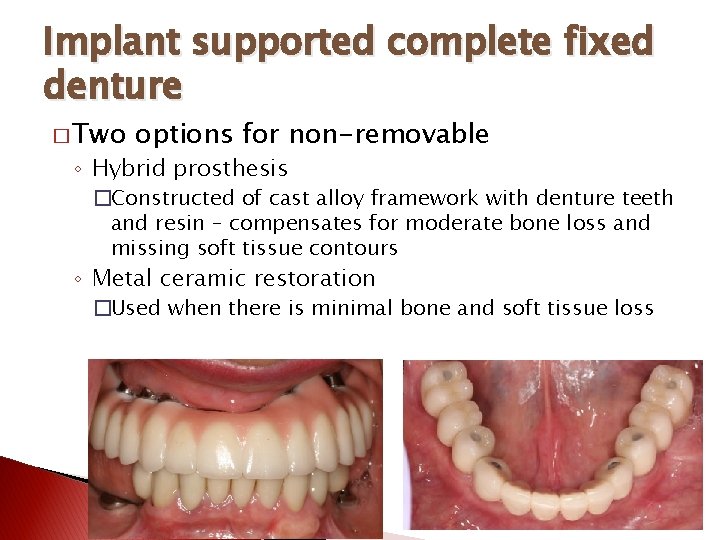 Implant supported complete fixed denture � Two options for non-removable ◦ Hybrid prosthesis �Constructed