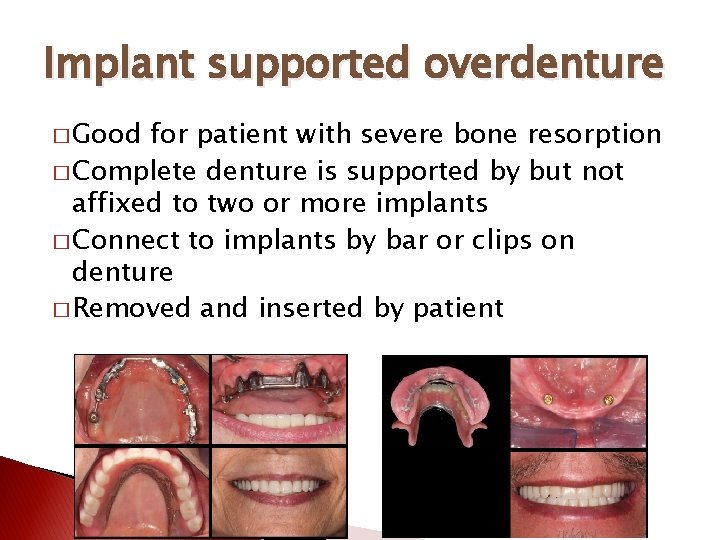 Implant supported overdenture � Good for patient with severe bone resorption � Complete denture