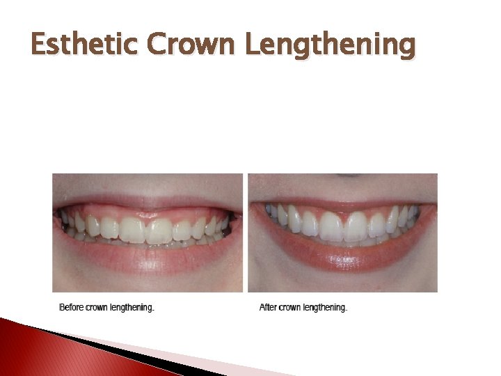 Esthetic Crown Lengthening 