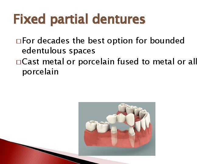 Fixed partial dentures � For decades the best option for bounded edentulous spaces �