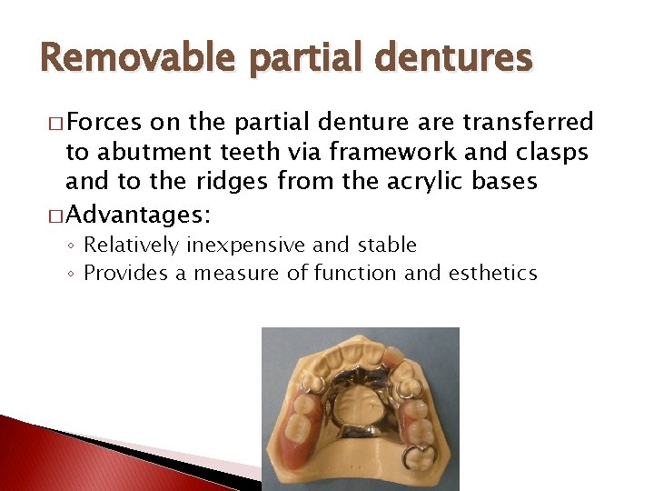 Removable partial dentures � Forces on the partial denture are transferred to abutment teeth
