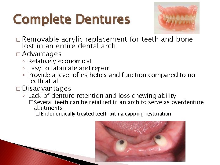 Complete Dentures � Removable acrylic replacement for teeth and bone lost in an entire